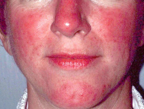Lupus Or Rosacea Test May Mislead